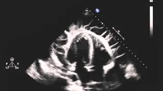 Echocardiogram of a Patient with Uremic Pericarditis.