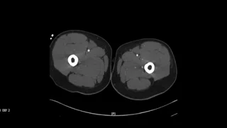 CT Aortic runoff