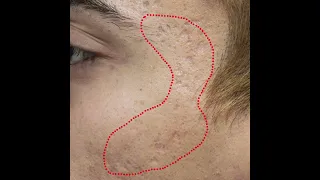 Acne Scar Treatment