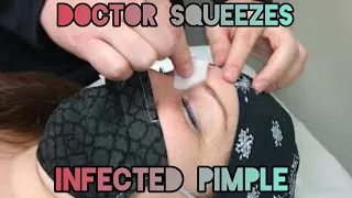 Abscessed Pimple Between Eyebrows | Infected Follicle