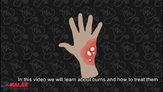 Burns First Aid | Malar - First Aid Online Course