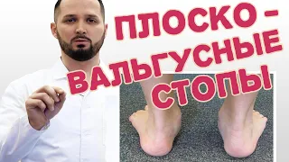 Плоско-вальгусная деформация стоп у детей