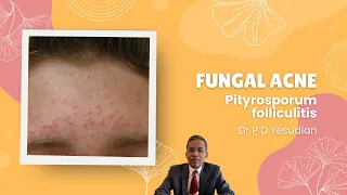 Pityrosporum or Malassezia folliculitis (fungal acne)