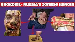 Dangers Of Krokodil- Russia's Zombie Heroin (AKA Desomorphine)