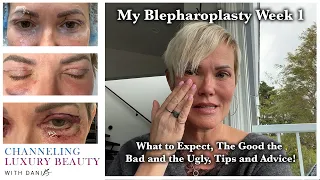 Blepharoplasty! Week 1 - Recovery & What to Expect! Eyelid Surgery & CO2! Channeling Luxury Beauty