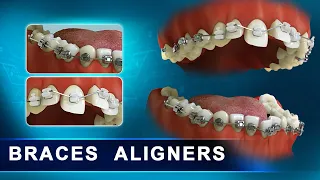 How Braces Aligners work - Elements of the Orthodontic treatment | Advanced 3d Dental Animation