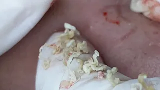 Pimples And Ingrown Hair P1 | Lông Mọc Ngược Gây Mụn P1 - SacDepSpa#198