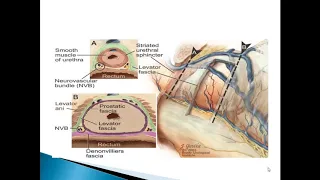 Urology Journal Club at SIUT on 20th August 2020: Localized Prostate Cancer: Radical Prostatectomy