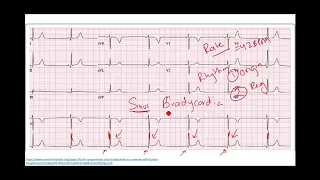 Module 3-Rhythm |EKG Fundamentals Series