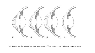 Lecture: Corneal Ectasia II - Dr  Sakshi Patil