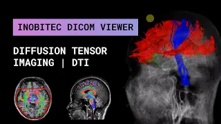 Diffusion Tensor Imaging (DTI) Fiber Tracking with polygonal mesh export