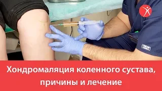 Хондромаляция коленного сустава, причины и лечение