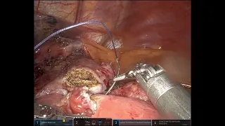 Robotic Revision with Gastrojejunostomy