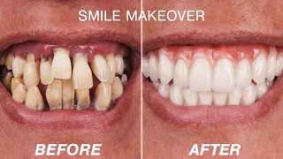 Before & After Smile Makeover Transformations | Cosmetic Dentistry Dental Boutique