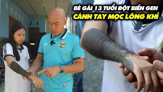 THIẾU NỮ 13 TUỔI MẮT CĂN BỆNH LẠ TAY MỌC LÔNG KHỈ