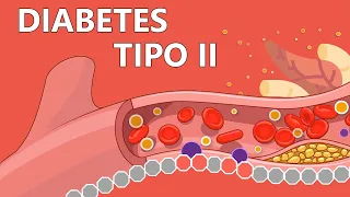 Diabetes tipo 2 - Explicada Fácilmente Para Pacientes