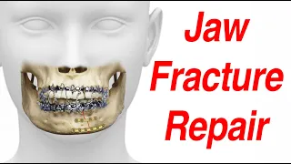 Jaw Fracture Surgical Treatment Animation (MMF - ORIF)