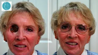 Orbital & Facial Prosthetics