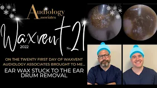 IMPACTED WAX AND EARDRUM PEEL - EP720