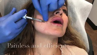 Corner of the Mouth Contouring - Omeed Sani MD - Sani Aesthetics