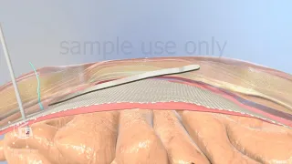 Abdominal hernia surgery | ventral hernia 3d medical animation | sample use only