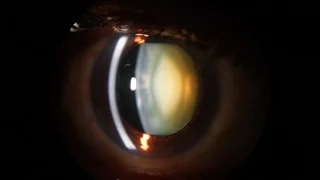 Slit Lamp examination of the anterior segment of the eye