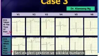 Mattu EKG Vakası: Wellens EKG Örnekleri - 19 Ağustos 2013