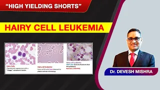 High Yielding Shorts-72 (#HYS-72):Hairy cell Leukemia by Dr. Devesh Mishra.