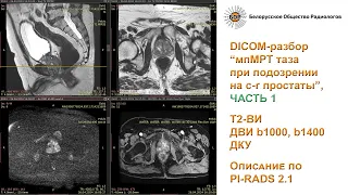 Мультипараметрическая МРТ таза при подозрении на рак простаты. Часть 1: описание по PI-RADS 2.1