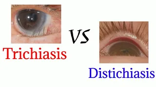 Difference between trichiasis and distichiasis - optometry club