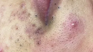 Big blackheads, whiteheads, pimple popping - Nhat Bang Acne Treatment - Chuyen Nguyen Spa #14