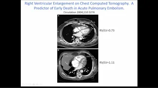 Advances in the Management of Pulmonary Embolism, From Early Discharge to Advanced Therapies