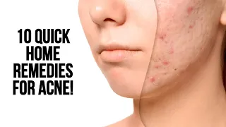 10 Quick Home Remedies For Acne!