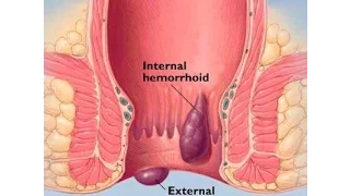 Hemorrhoid and how to have Normal bowel movement by Doc Willie Ong