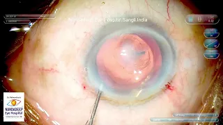 Corneal opacity Dr Sourabh Patwardhan Live Cataract surgery. For consultation call 9220001000