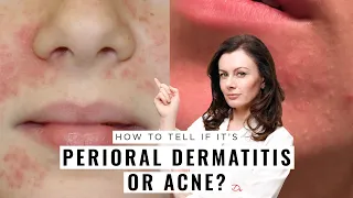 Perioral Dermatitis or Acne? How to Tell the Difference | Dr Sam Bunting