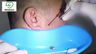 Hard Ear wax removing 😳😳😳Asmr #Asmr #viral #trending