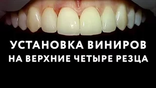 Виниры на зубы в Москве. Установка виниров на передние зубы