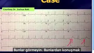 Mattu EKG Vakası -- Makine yorumuna güvenmeyin -- 23 Eylül 2013