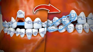 How braces are put on - Step by step