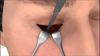 Eye Fracture Surgery - 3D medical animation