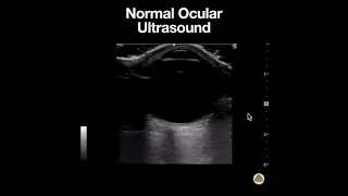 Normal Ocular Ultrasound Anatomy