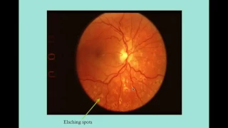 Hypertensive Retinopathy   CRASH! USMLE Step 2 and 3