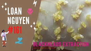 Blackheads obsession of so many you are infected 161 | Loan Nguyen