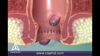 Learn about hemorrhoids with #3d #animation