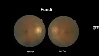 Mass General Grand Rounds: Case Record Review with Meridale Baggett, MD