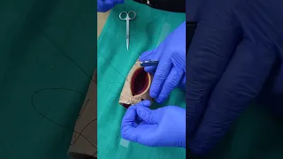 Babu and Magon Technique of Uterine closure during LSCS.