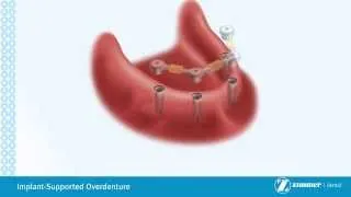 Implant Supported Overdenture