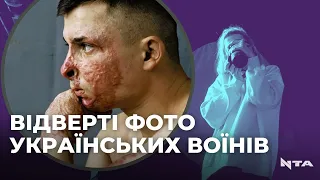 Без кінцівок і з опіками: фотограф зі Львова показує наслідки війни