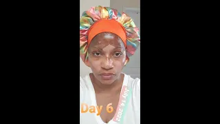 40 + yr old Black Woman does 25% TCA chemical peel again Part II